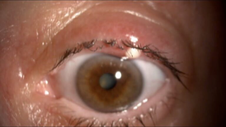 Sorprendente: ¿Por qué aparecen ampollas en el párpado superior del ojo?