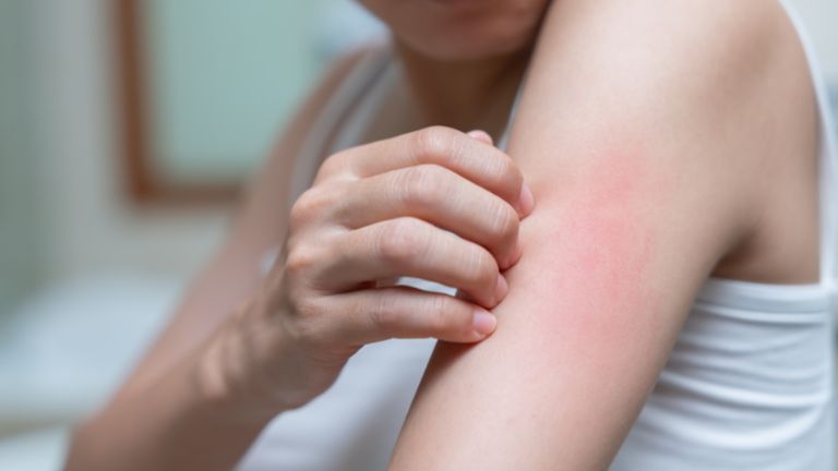 Descubre el Brillo sin Irritación: Alivia la alergia al sol con la crema con corticoides