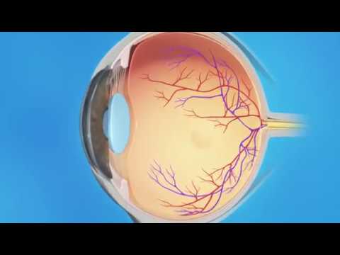 Cuidados esenciales tras láser de argón en la retina